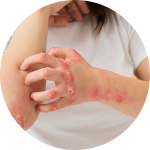 My dermatitis won’t go away, and ointments don’t help.