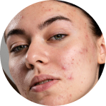 I have breakouts on my skin.