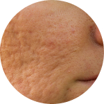 These acne scars are ruining my life.