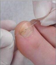 Treatment of Problem Nails (e.g., ingrown nails, bracing systems, etc.) and Nail Brace Adjustment