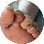 Diabetic foot
