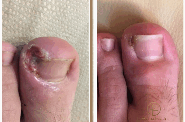 Ingrown toenail