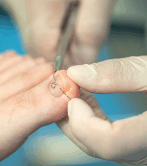 Treatment of problem nails (such as correction systems, etc.) and adjustment of nail braces