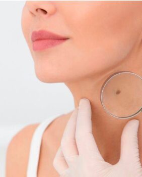 Skin Neoplasms: Diagnostics and PlasmaHealth Treatment
