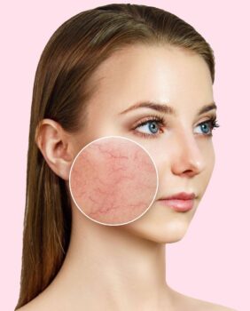 Couperose. Apparative und pharmakologische Methoden von PlasmaHealth