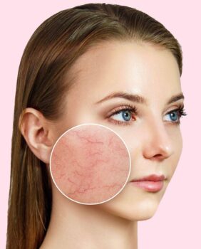 Couperose. Apparatieve en Farmacologische Methoden van PlasmaHealth