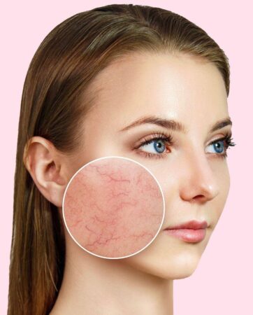 Couperose. Apparatieve en Farmacologische Methoden van PlasmaHealth