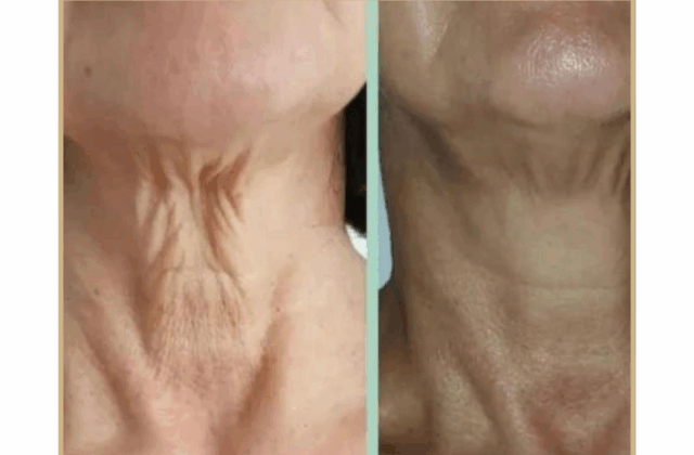 Neck Lift - Derma Fract ION and MesoSculpt