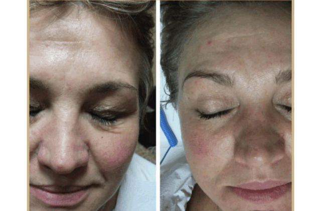 Gentle Eyelid Lift - Derma Fract ION