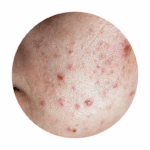 Treating uneven skin texture, post-acne scars, and atrophic post-acne scars