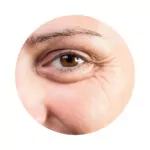 I am concerned about my drooping eyelids.