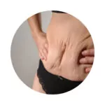 I want to reduce stretch marks and scars on my body.