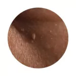 I want to remove excess skin and feel discomfort due to warts and skin growths.